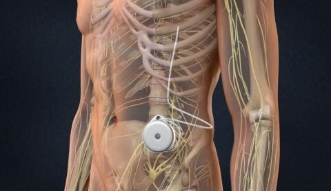 Intrathecal Pump Implantation